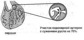 Избыток жиров в пище создает условия для развития атеросклероза уплотнения и - фото 1