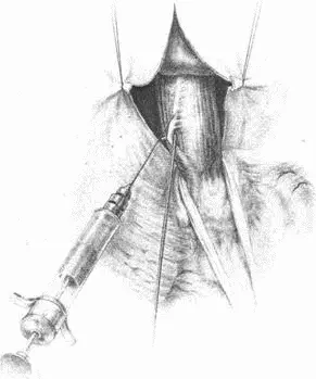 Рис 76Сагитальная диафрагмотомия Анестезия и пересечение левого блуждающего - фото 102