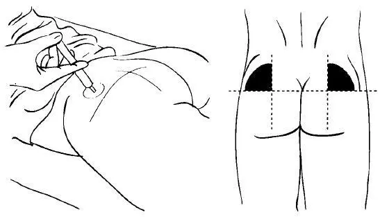 Рис 1Техника внутримышечных инъекций и ягодицу Чаще всего для внутримышечных - фото 1