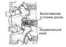 б Рис 13Этапы дегенеративного изменения позвоночника а сдвиг отростка - фото 6