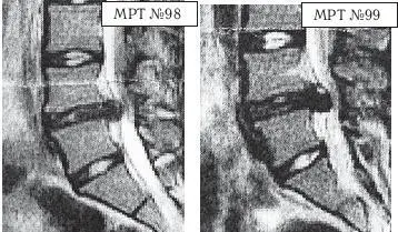 На МРТ 98 у той же пациентки наблюдается послеоперационный рецидив грыжи - фото 117