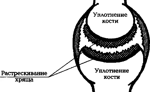 Илл 2а 1я стадия артроза Весь комплекс перечисленных нарушений приводит к - фото 2