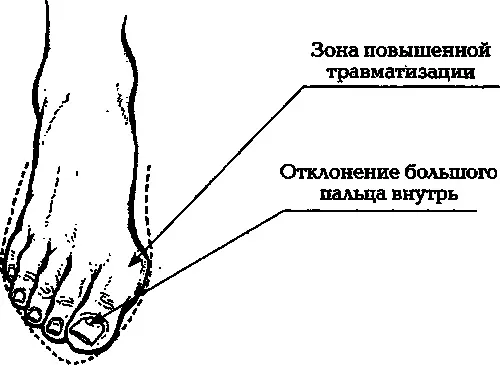 Илл 4 Воздействие узкой обуви на стопу В результате давления обуви большой - фото 6