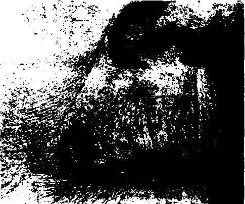 Рис 1160 Бородавчатый предрак Узелок покрытый серыми чешуйками на красной - фото 248