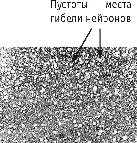 Рис 7Губкооб разные изменения в коре головного мозга 14летнего мальчика - фото 17