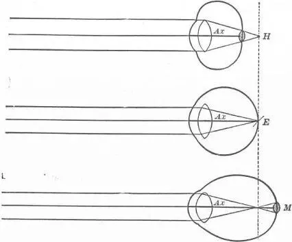 Рис 4 Диаграмма Гиперметропического Эмметропического и Миопического Глазных - фото 5