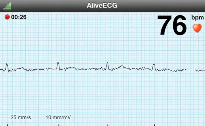 AliveCor показывает в реальном времени кардиограмму отмечает интервалы между - фото 64