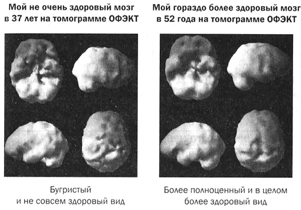 ОФЭКТ ядерное медицинское исследование позволяющее наблюдать кровообращение - фото 12
