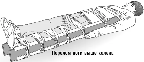 Перелом ноги выше колена Перелом ноги ниже колена Если вы подозреваете - фото 118