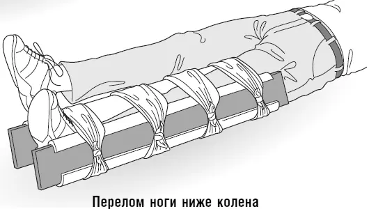 Перелом ноги ниже колена Если вы подозреваете что сломана коленная чашечка - фото 119