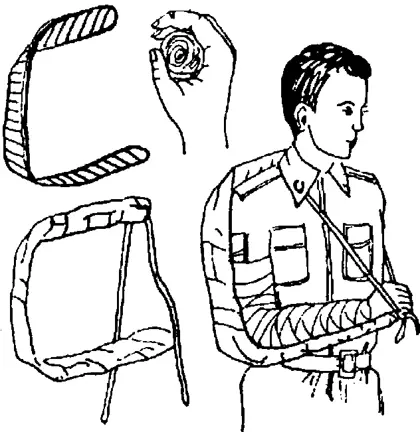 Рис 48 Транспортная иммобилизация верхней конечности лестничной шиной 79 - фото 49