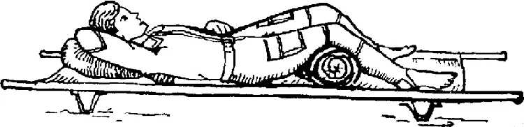 Рис 410 Транспортная иммобилизация при переломах костей таза на носилках - фото 51