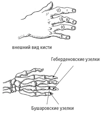 Рис 22 Артроз запястнопястного сустава I пальца встречается столь же часто - фото 49