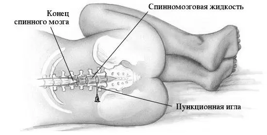 Спинномозговую поясничную пункцию берут ниже спинного мозга так что игла не - фото 223