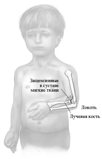 Подвывих головки лучевой кости болезненная травма распространенная у детей - фото 228