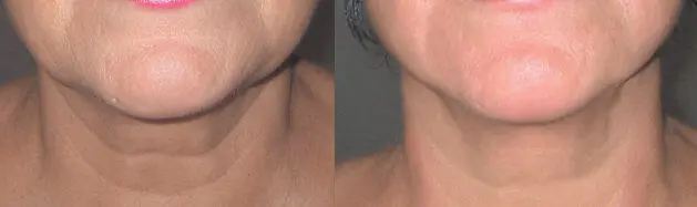 Улучшение линии наклона челюсти восстановление симметрии и объема жевательных - фото 135