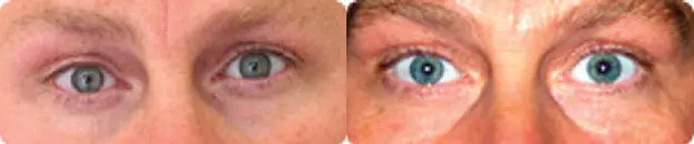 Увеличение глаз связанное с коррекцией формы лица Часто глаза визуально - фото 180