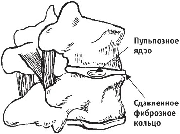 Рис 24Протрузия диска Чем сильнее стягиваются смежные позвонки - фото 29
