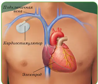 Имплантация электрокардиостимулятора Постоянная электрическая стимуляция - фото 24