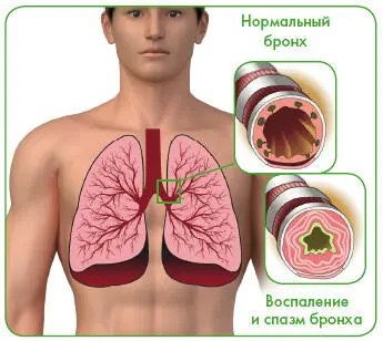 Причиной заболеваниямогут быть различные аллергены лекарственные препараты - фото 48