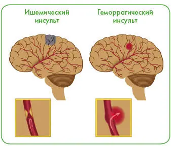 При гемморрагическом инсульте все симптомы гораздо более выражены чем при - фото 113