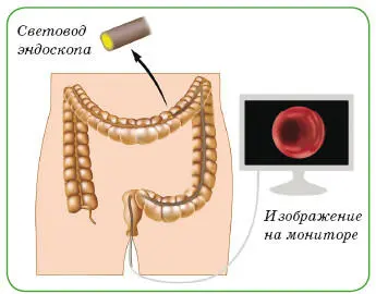 Колоноскопия Для уточнения диагноза врач может назначить эндоскопическое - фото 122