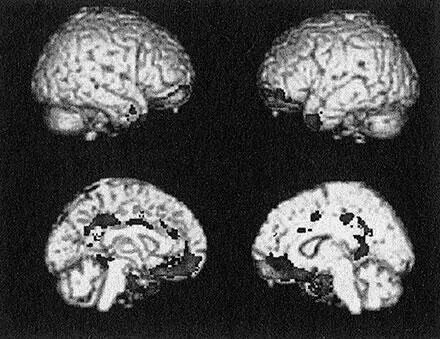 Рис 8 Результаты первого анализа данных структурной МРТ по осужденным - фото 8