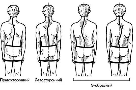 Рис 49 Формы сколиоза Но и это еще не все В зависимости от расположения - фото 52