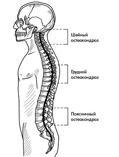 Рис 66 Локализация остеохондроза Шейный остеохондроз При шейном - фото 70