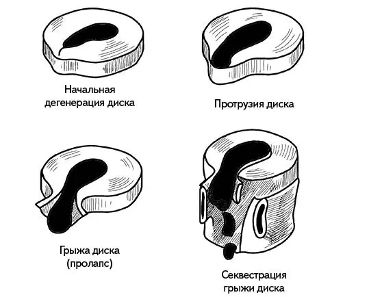 Рис 68 Стадии формирования грыжи диска На второй стадии разрушение диска - фото 72
