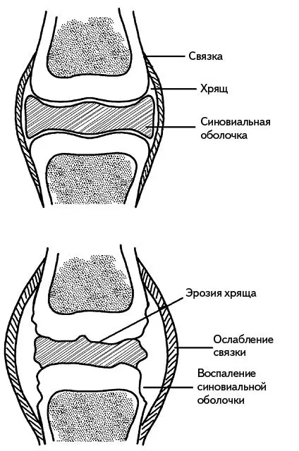 Рис 152 Изменения в суставах при артрите Артриты довольно сложно - фото 160