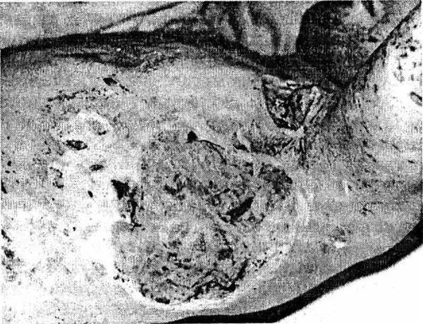 Рис 1 Обширные гранулирующие раны грудной клетки Макроскопически при - фото 1