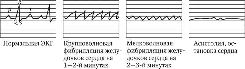 Рис 54 Динамика работы сердца в период состояния клинической смерти - фото 63