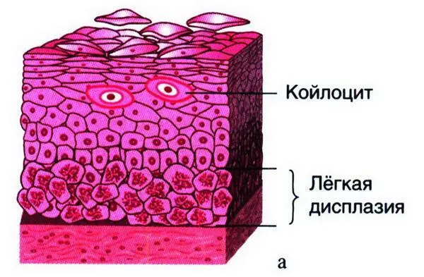 Рис 1550 Дисплазия разной степени выраженности а легкая изменения - фото 29