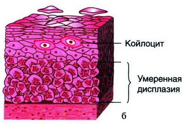 Рис 1550 Дисплазия разной степени выраженности а легкая изменения - фото 30