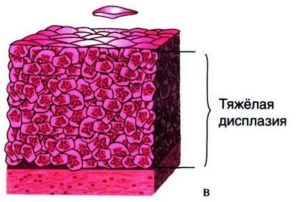 Рис 1550 Дисплазия разной степени выраженности а легкая изменения - фото 31