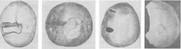 Эти фотографии из коллекции кафедры судебной медицины Одесского медицинского - фото 73