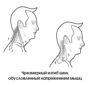 При наличии развитого артроза шеи гиперлордоз может способствовать сжиманию - фото 258
