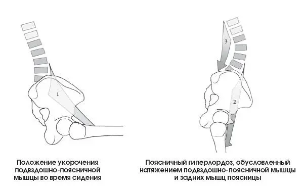 В положении стоя укороченные мышцысгибатели тянут таз перемещая его в - фото 266