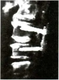 Рентгенограмма позвоночника фиксированного методом транспедикулярной фиксации - фото 83