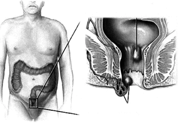 Рис 41 Геморроидальные узлы Задний проход является конечным отделом прямой - фото 84