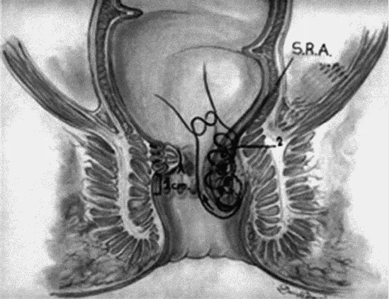 Рис 4 4 Хирургический способ лечения геморроя Продолжительность операции - фото 90