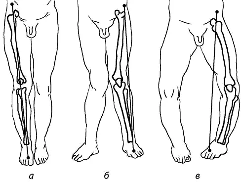 Рис 116 Вид нижних конечностей а при нормальном прохождении оси б при - фото 16