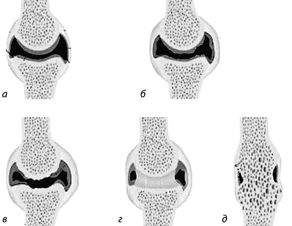Рис 27 Стадии развития ревматоидного артрита а здоровый сустав б І - фото 24