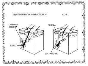 Угри угревая сыпь акне это хроническое воспалительное заболевание сальных - фото 19