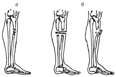 Рис 42 Переломы а закрытый б открытый Основные признаки закрытых - фото 2