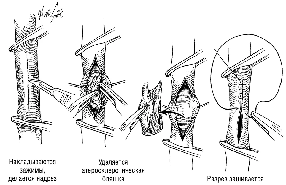 Рисунок 55 Технология проведения каротидной эндартерэктомии Иллюстрация - фото 36