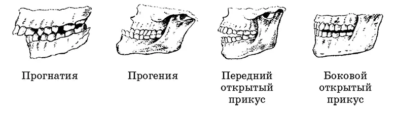Рис 19 Патология челюстнозубного ряда Прогнатия верхняя челюсть и - фото 19