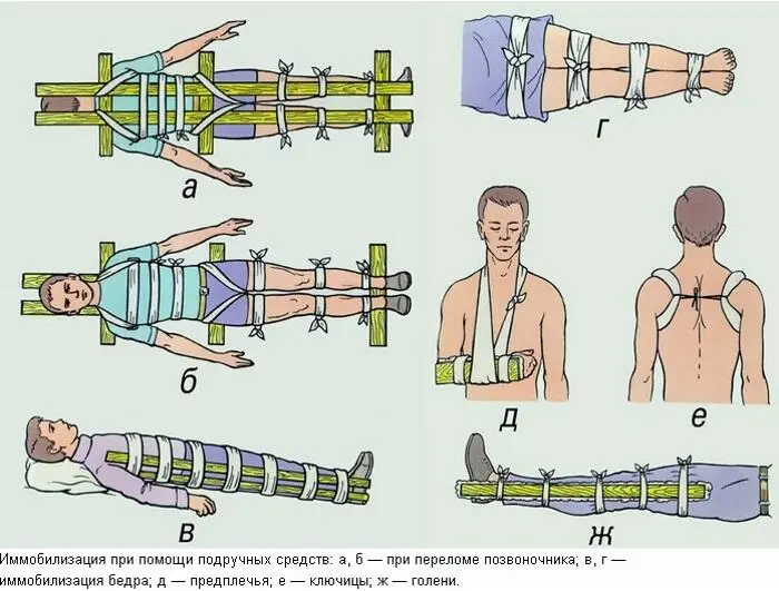 Рис 74 Наложение шины при переломе костей стопы голени и бедра - фото 89