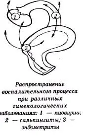 Эндометритом называется воспаление слизистой оболочки матки сопутствующее - фото 49